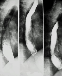 Esofagograma con Esofagitis