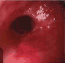 Endoscopia con Esofagitis