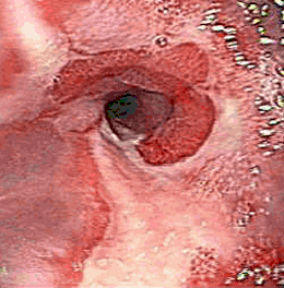 Endoscopia con Esofagitis